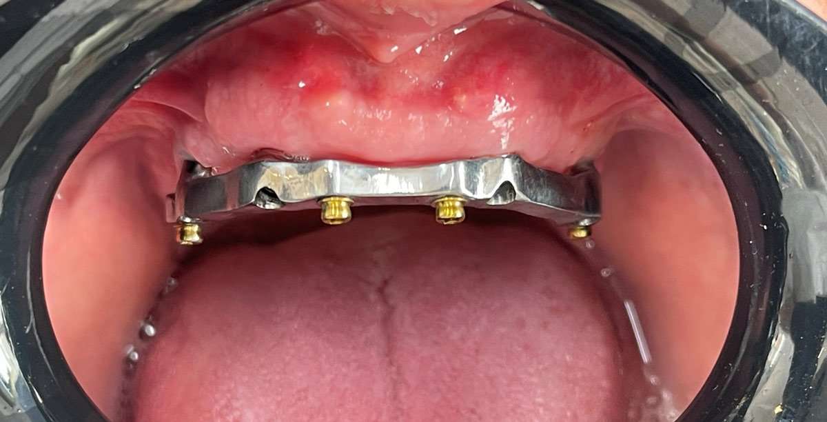 protetica dentara Cluj, implant dentar Cluj