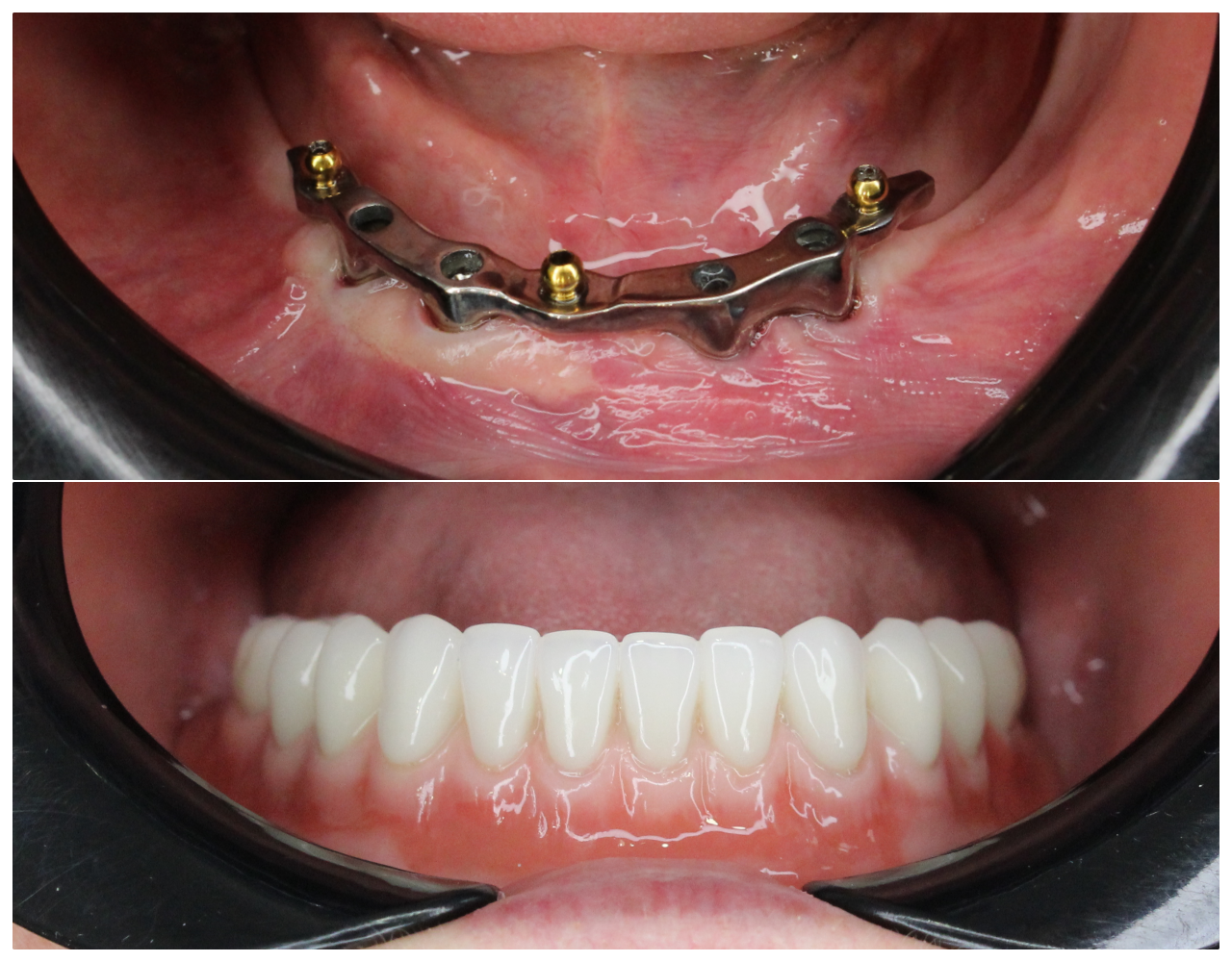 tehnica cu implant dentar All-on-4 Cluj, reabilitare dentara Cluj