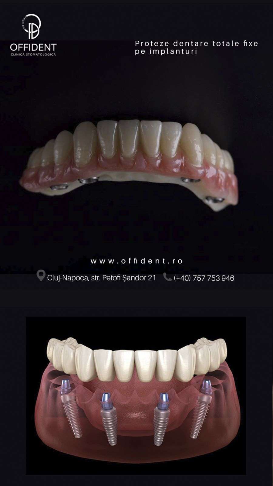proteze dentare fixe pe implant Cluj