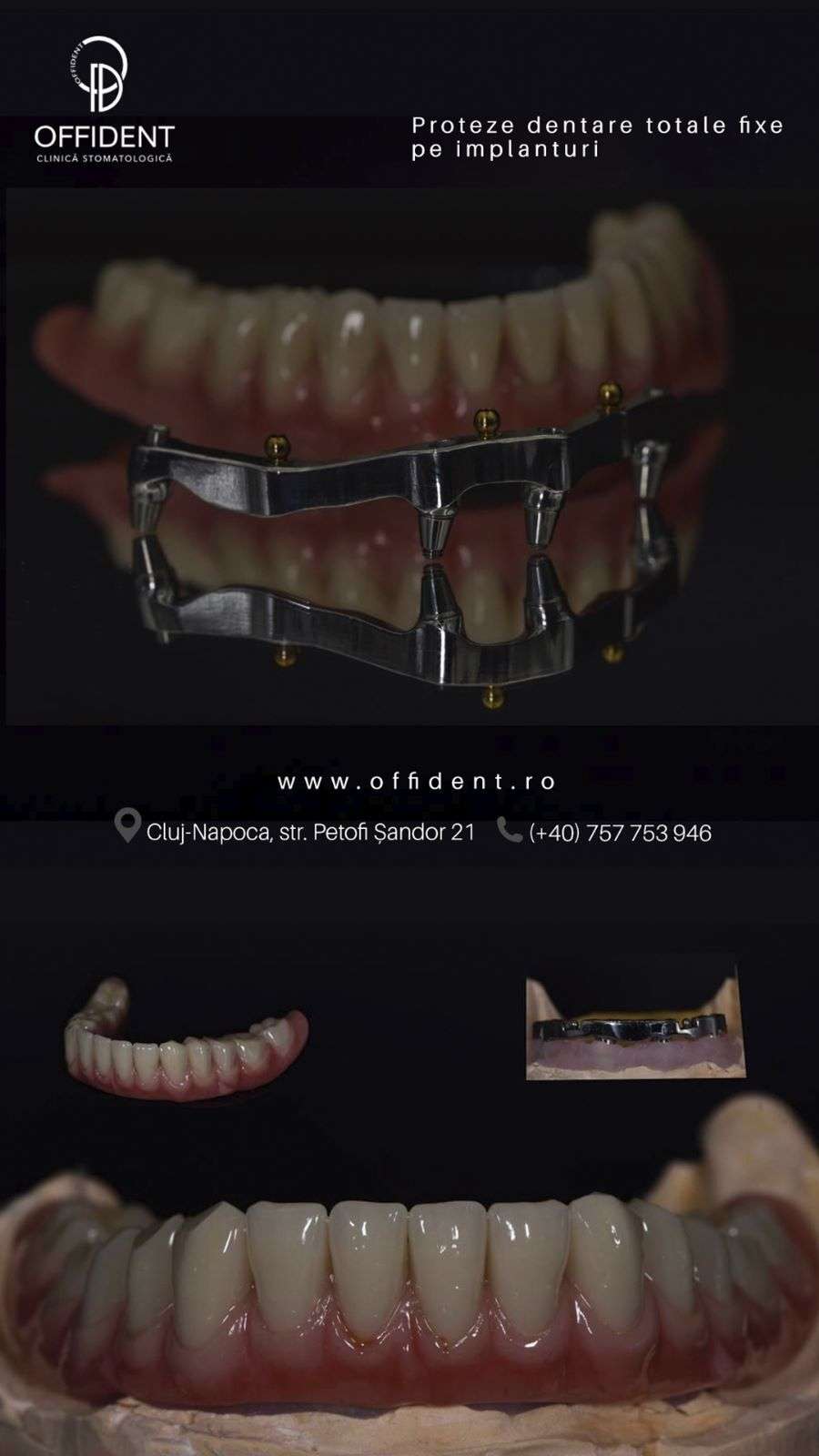 proteze dentare fixe pe implant Cluj