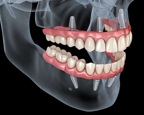 All on 4 Cluj, implant dentar Cluj, reabilitare orala