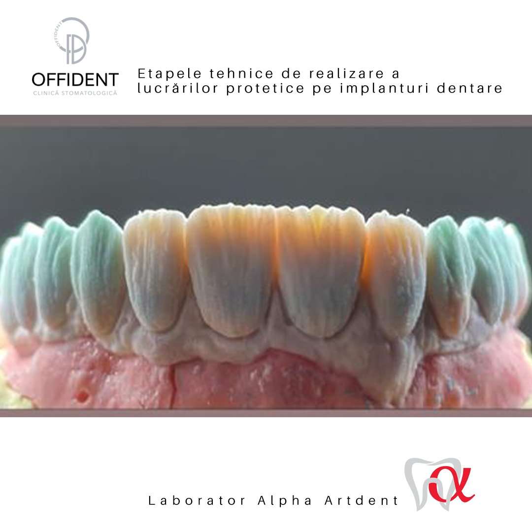 Etapele tehnice de realizare a lucrărilor protetice pe implanturi dentare