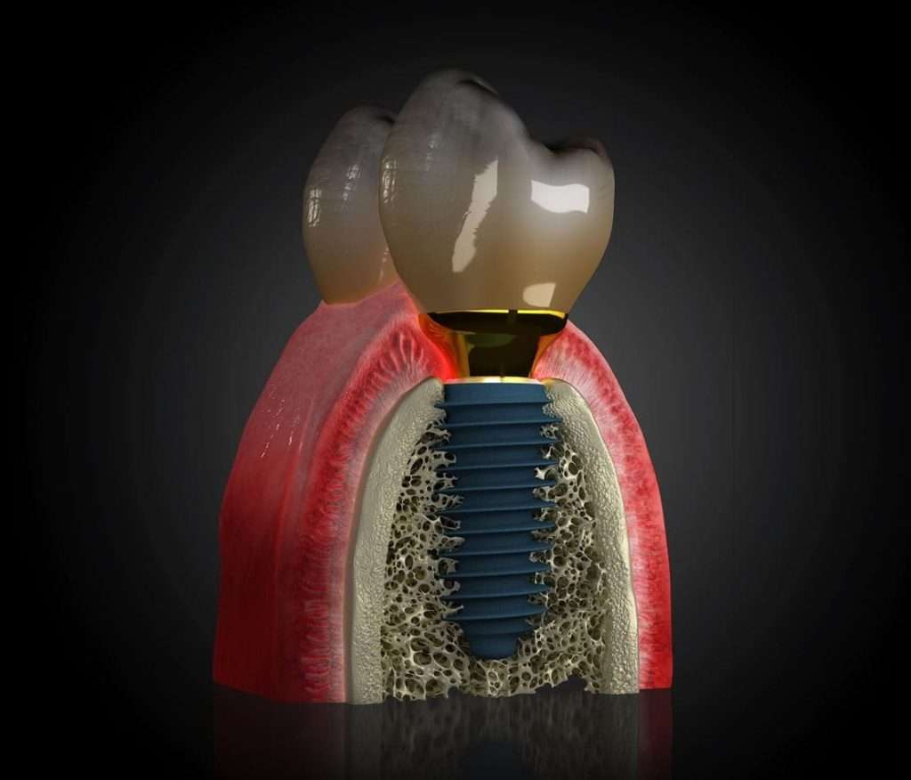 Implant dentar Megagen Cluj